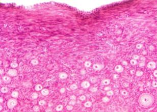 + OVARIAN TISSUE CRYOPRESERVATION Age Tumor AMH f/mm3 11 Ewing Sarcoma 1.4 2200 13 Medulloblastoma 0.