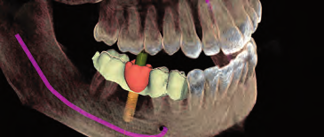 10 I 11 QUELLO CHE CONVINCE I PAZIENTI! Radiografie e CAD/CAM insieme: con lo straordinario processo di implantologia integrata, per un impianto perfetto sono necessarie al massimo tre sedute.