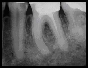 E evidente che, in presenza di una conicità.06, il collocare a circa 5 mm.