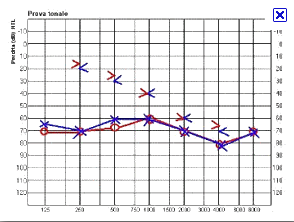 CURVE AUDIOMETRICHE Le ipoacusie di 0po misto sono carauerizzate da una riduzione sia