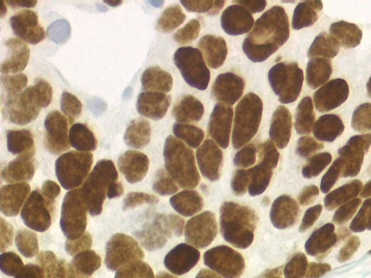 Epoca della immunoistochimica CD56 Biopsia