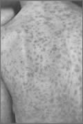 MORBILLO o prima malattia Eziologia: Morbillivirus, Paramixoviridae Via di contagio: goccioline di Flugge di un soggetto nello stadio prodromico o eruttivo precoce della malattia; raro mediante