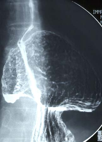 Concentric hiatus hernia Recurrence