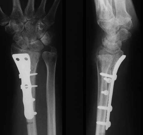 INSUCCESSI DELL FISSZIONE ESTERN NELLE FRTTURE DEL RDIO DISTLE 125 C Figura 4. (): Frattura lussazione articolare che coinvolge la metafisi con frammenti ruotati e incarcerati. (): Riduzione con F.E. in neutralizzazione, placca volare, viti interframmentarie,fili di K.