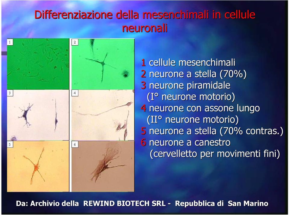 lungo (II neurone motorio) 5 neurone a stella (70% contras.