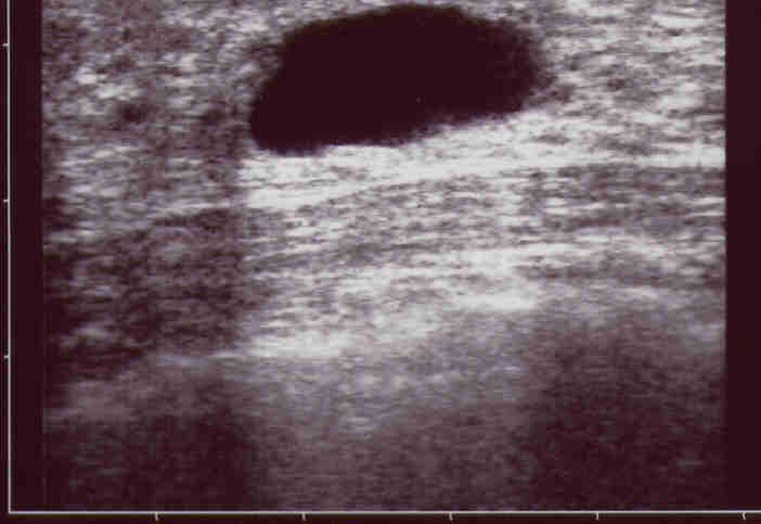 Rinforzo posteriore (plus) Attraverso una struttura liquida gli echi sono quasi interamente trasmessi, mentre nei