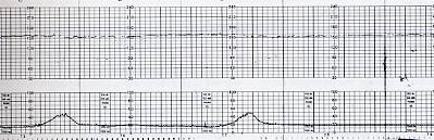Decelerazioni tardive lievi La depressione miocardica impedisce al feto di rispondere a stimoli