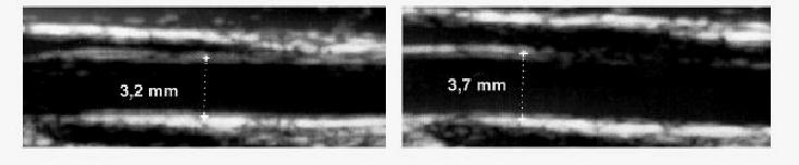 L introduzione di un metodo basato sull ultrasonografia B-mode ha costituito un reale passo in avanti nella valutazione non invasiva della FE: tale metodo misura cambiamenti nel diametro dell aa.