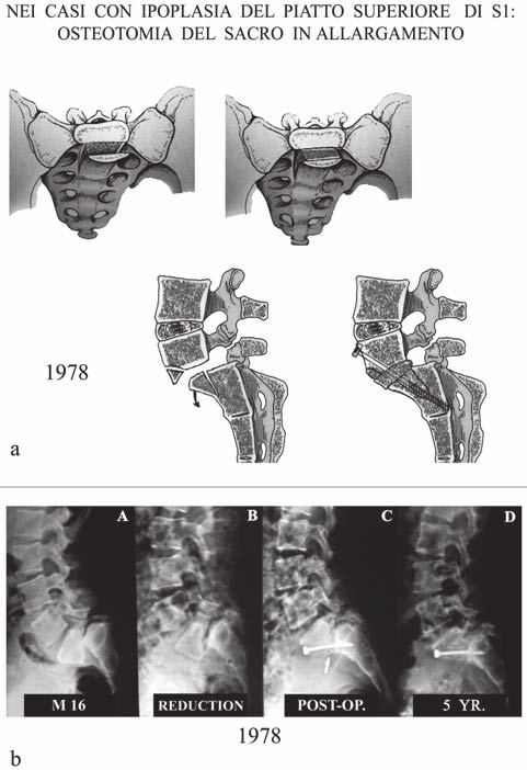 Gli inizi della nostra attività chirurgica nel trattamento delle deformità vertebrali Fig. 10. A. la schematizzazione dell intervento di osteotomia in allargamento del sacro. B.