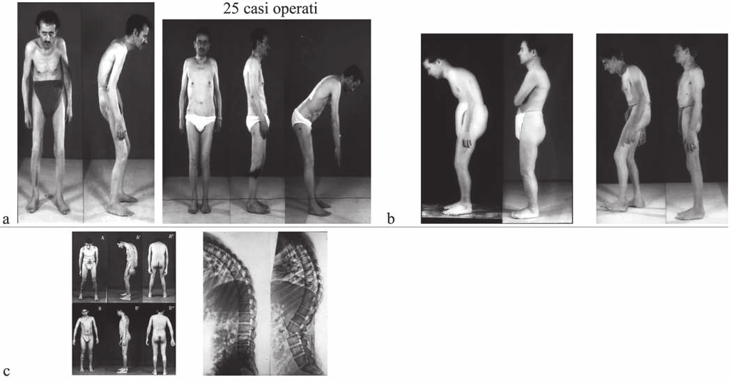 P.G. Marchetti, et al. Fig. 13. A. La osteotomia-resezione da noi usata. B. La tecnica di correzione (vedi testo). Fig. 14. A. Il corsetto gessato deambulatorio a circa 8 settimane.