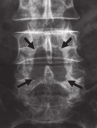 La stenosi lombare: dalla laminectomia agli spaziatori interspinosi vertebrale in sezione assiale.