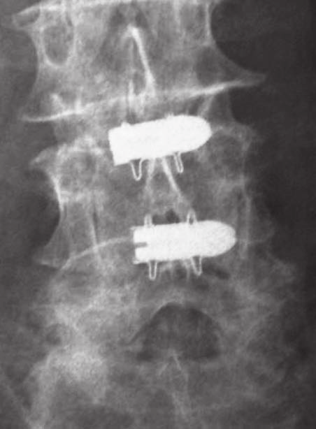 La stenosi lombare: dalla laminectomia agli spaziatori interspinosi un artrodesi postero-laterale può più facilmente esitare in pseudoartrosi, mentre con un artrodesi intersomatica si rischia di