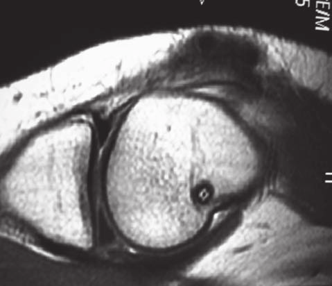 A. Schiavone Panni, et al. Fig. 3. Il punto isometrico del tunnel femorale giace in posizione posteriore e prossimale rispetto all epicondilo mediale e distale al tubercolo degli adduttori. Fig. 2.