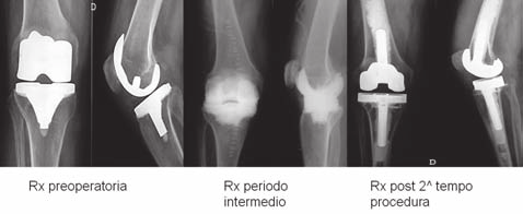 Utilizzo degli spaziatori articolati preformati nelle protesi infette di ginocchio L esame radiografico del ginocchio in proiezione A-P sotto carico, laterale e tangenziale di rotula secondo Merchant