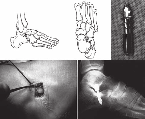 G.I.O.T. 2008;34(suppl. 1):S196-S199 Biofeedback seno-tarsico nel trattamento del piede calcaneo-valgo infantile Tarsal sinus biofeedback in the treatment of the calcaneovalgus foot in children G.