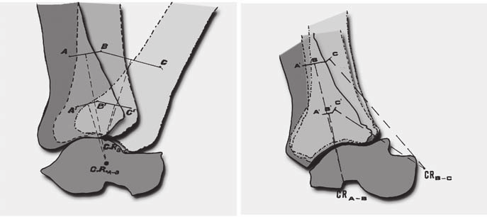 D. Vittore, et al. B A Fig. 1. A. Protesi Pipino-Calderale (prima versione). B. Protesi Pipino-Calderale (versione definitiva).