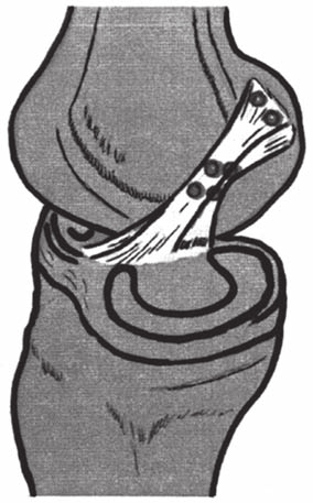 G. Cerulli, et al. Fig. 1. Terminazioni nervose sul LCA.