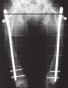 Il trattamento chirurgico della displasia fibrosa dello scheletro in accrescimento mediante osteotomie multiple sintetizzate con chiodi endomidollari, sono stati necessari una media di 4 interventi