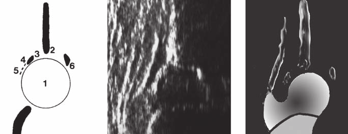 Diagnosi precoce della displasia congenita dell anca. Implicazioni terapeutiche S54 Fig. 1.