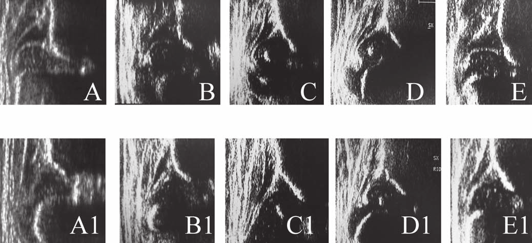 Diagnosi precoce della displasia congenita dell anca. Implicazioni terapeutiche Fig. 3.