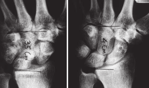 Correzione della instabilità scafolunare Poi con un bisturi n 11 si penetra nello spazio tra scafoide e semilunare, che solitamente è riempito di tessuto fibroso più o meno sclerotico a seconda dell