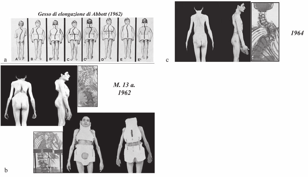 Gli inizi della nostra attività chirurgica nel trattamento delle deformità vertebrali Fig. 1. A. La schematizzazione della tecnica correttiva-contentiva di Cobb.