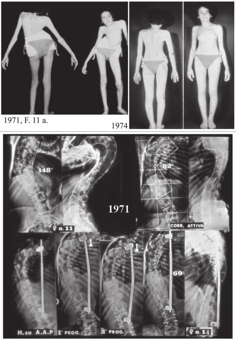 P.G. Marchetti, et al. Fig. 3. A. Le 2 coppie di vertebre artrodesizzate. B. La applicazione (dopo 4-6 mesi) nelle artrodesi apicali dei 2 uncini. C.