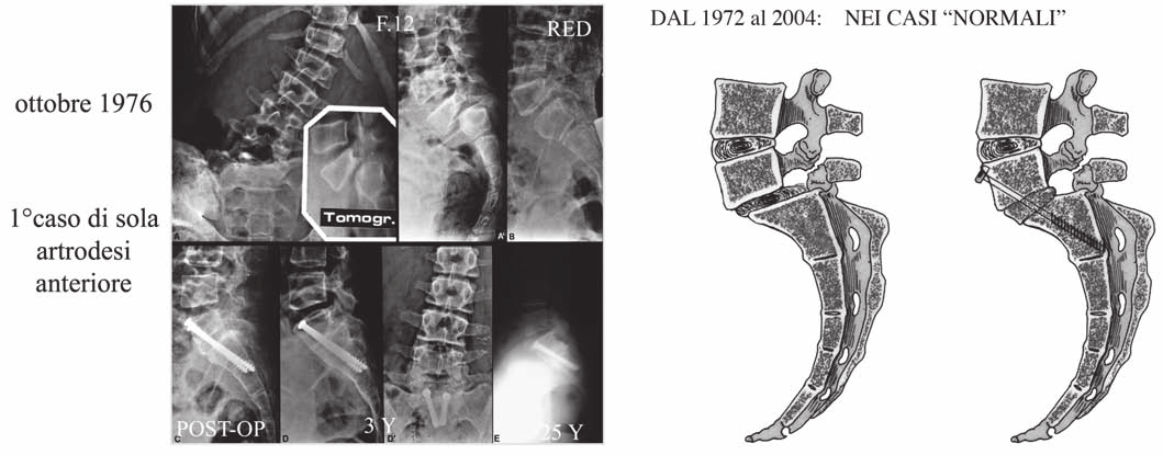 P.G. Marchetti, et al. SPONDILOLISTESI Visti i risultati ottenuti nelle scoliosi, alla fine degli anni 60 il prof. Scaglietti volle affrontare anche il problema delle spondilolistesi.