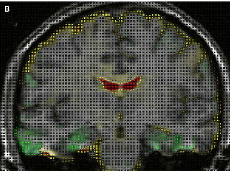 Change in brain volume over time in a woman with familial