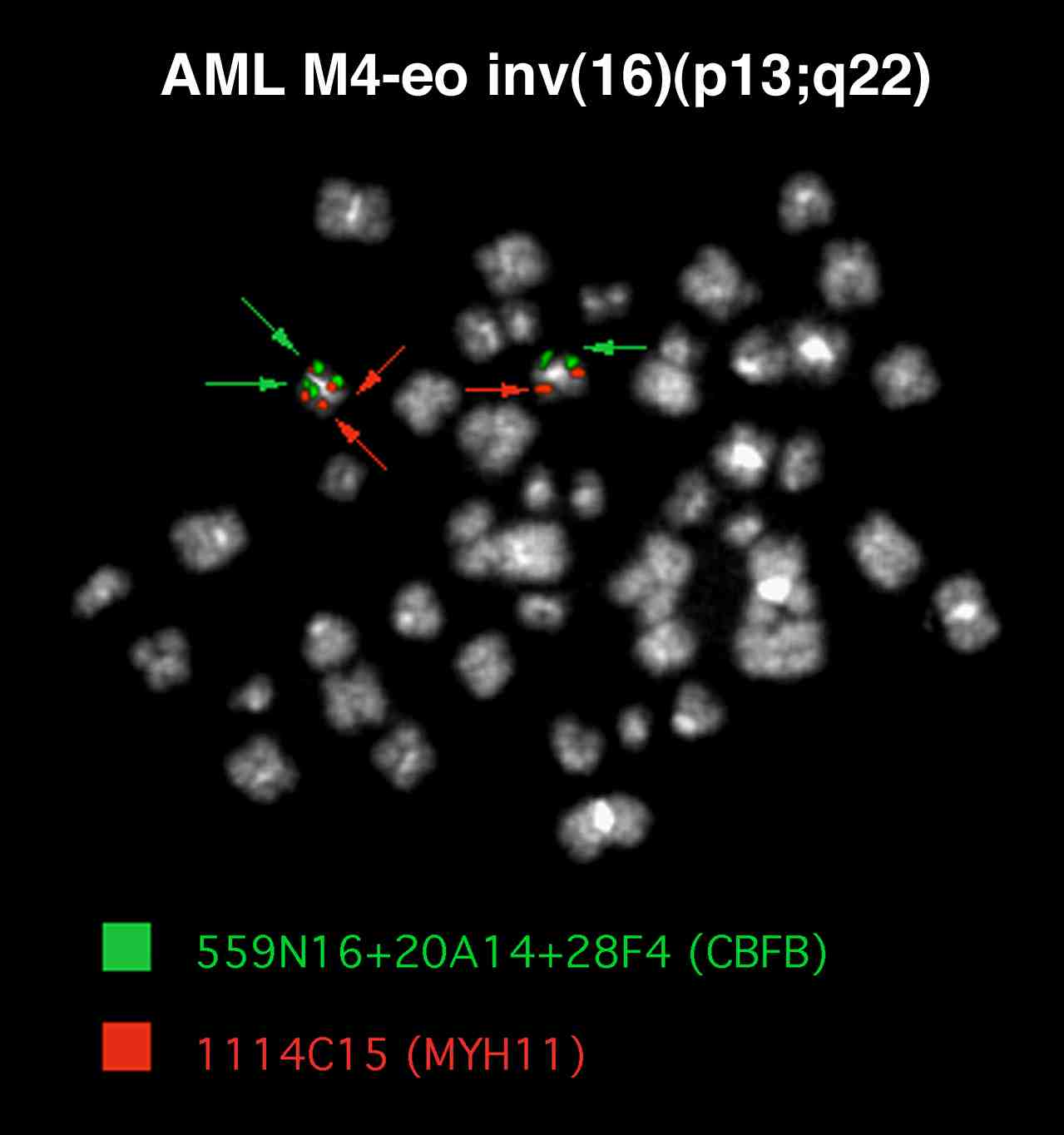 AML, Leucemia