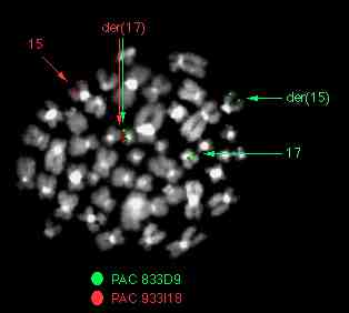 Leucemia Acuta Promielocitica (APL) geni coinvolti PML-RAR ) La traslocazione t(15;17) (q22;q21) è