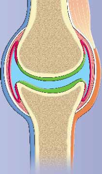 azione antinfiammatoria e analgesica. Acido Ialuronico lenifast gel liquido sinoviale Costituente del liquido sinoviale e della Cartilagine articolare.