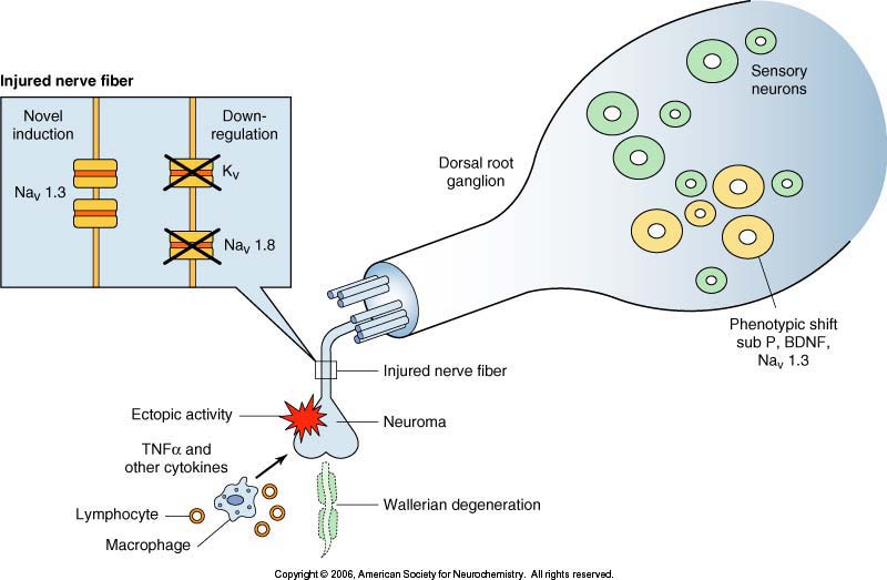 Il dolore neuropatico è legato in prima istanza all ipereccitabilità dei neuroni sensitivi di I ordine A delta e C attraverso la iperespressione di canali per il sodio voltaggio dipendenti Fibre