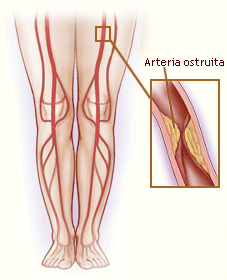 Che cos'è l'arteriopatia periferica?