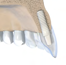 b a a L b c D 3 mm 1,5 mm 1,5 mm 1,5 mm 1,5 mm Diametro della spalla D [mm] Larghezza min del gap [mm] Distanza min tra i denti a livello osseo [mm] Diametro della spalla D 1 [mm] Diametro della