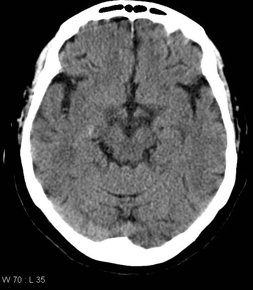 Ischemia cerebellare e pontina da multiple stenosi dell arteria basilare: