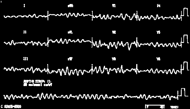 Fibrillazione atriale Polso totalmente aritmico e diseguale > ALTERAZIONE DI RITMO, AMPIEZZA, DURATA (e FREQUENZA) Fibrillazione