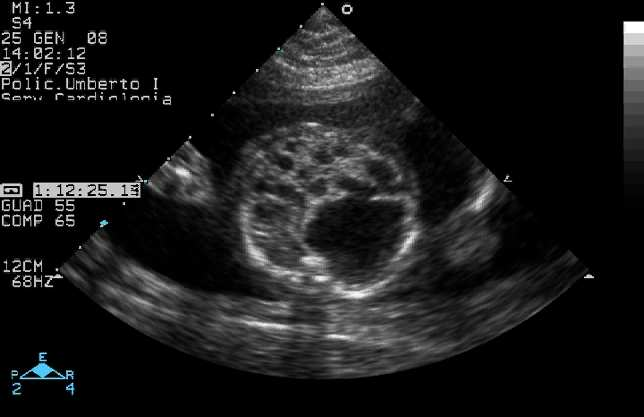 Valore assoluto dei casi di Cardiopatie