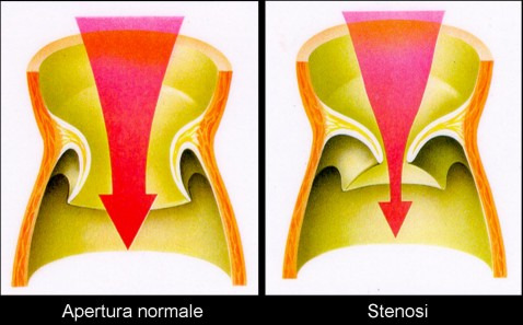 Principali malattie valvolari: Stenosi (R Energia necessaria