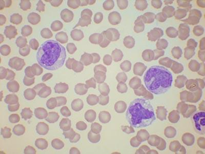 Leucemia mielomonocitica cronica