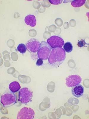 Leucemia mielomonocitica cronica LMMC