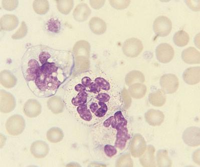 Leucemia mieloide cronica atipica