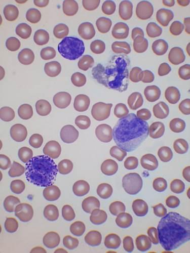 Leucemia mieloide cronica atipica