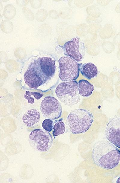 Leucemia mielomonocitica giovanile Periferico Midollo Bain BJ,