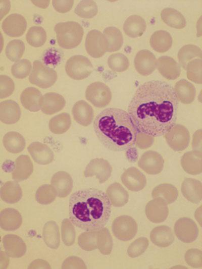 Anemia refrattaria con sideroblasti Periferico ad anello e trombocitosi