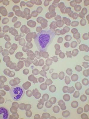 Leucemia mielomonocitica cronica È importante non confondere