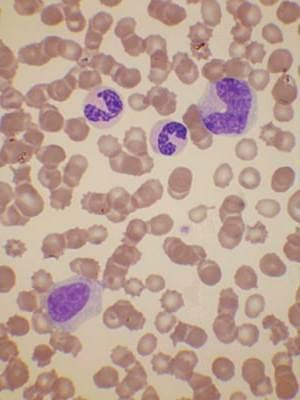 Leucemia mielomonocitica cronica È importante non confondere promonociti e monociti