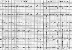 esempio nella sindrome X, ipertensione arteriosa, diabete e /o