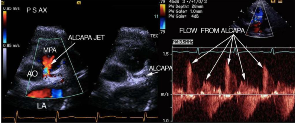 - Al centro un asse corto sull aorta mostra la coronaria