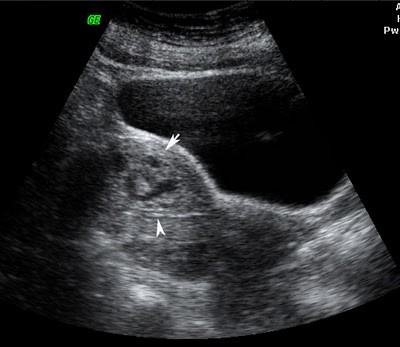 Tipologie Doppler Bianco e nero: classico Eco doppler Modalità colore : ( Color Flow modes) a seconda del parametro mappato: Varianza